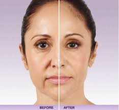 Botox_1 Botox_1