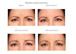 botox_2 botox_2