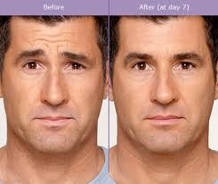 botox_3 botox_3