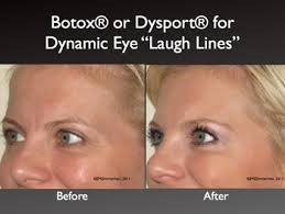 botox_4 botox_4