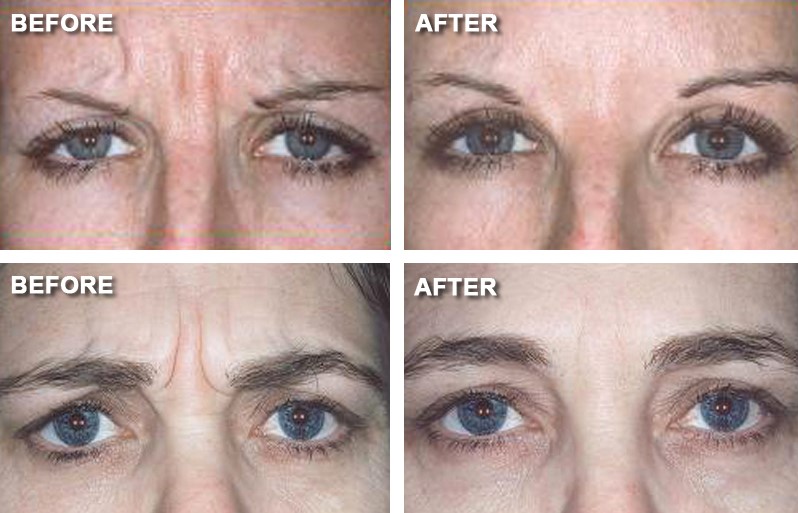 botox_5 botox_5