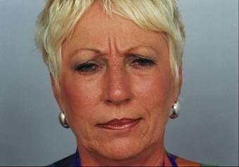 botox_6 botox_6