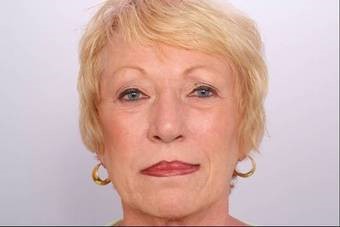 botox_7 botox_7